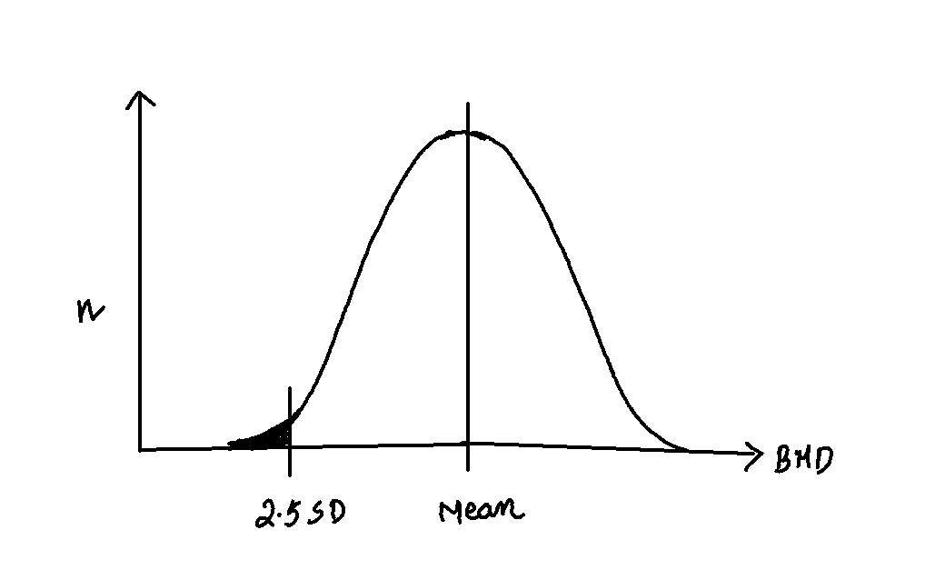 Bell curve showing osteoporosis zone