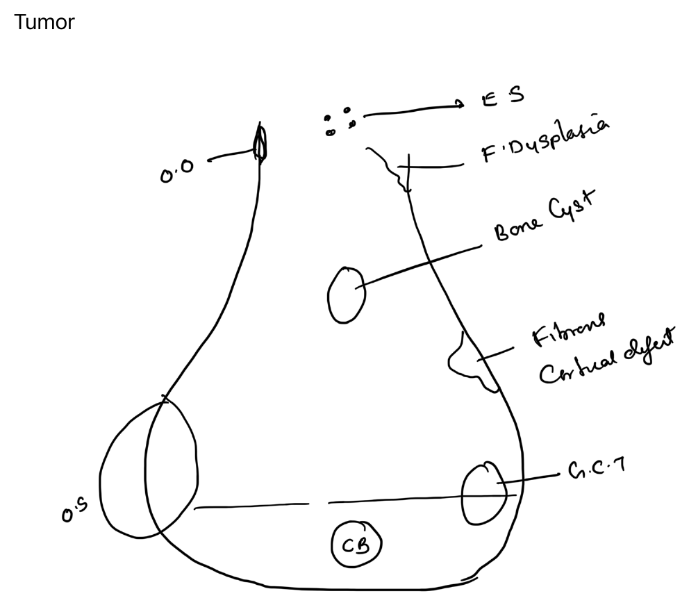 Distribution of bone tumours