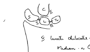 Carpal relationship in lunate and perilunate injury