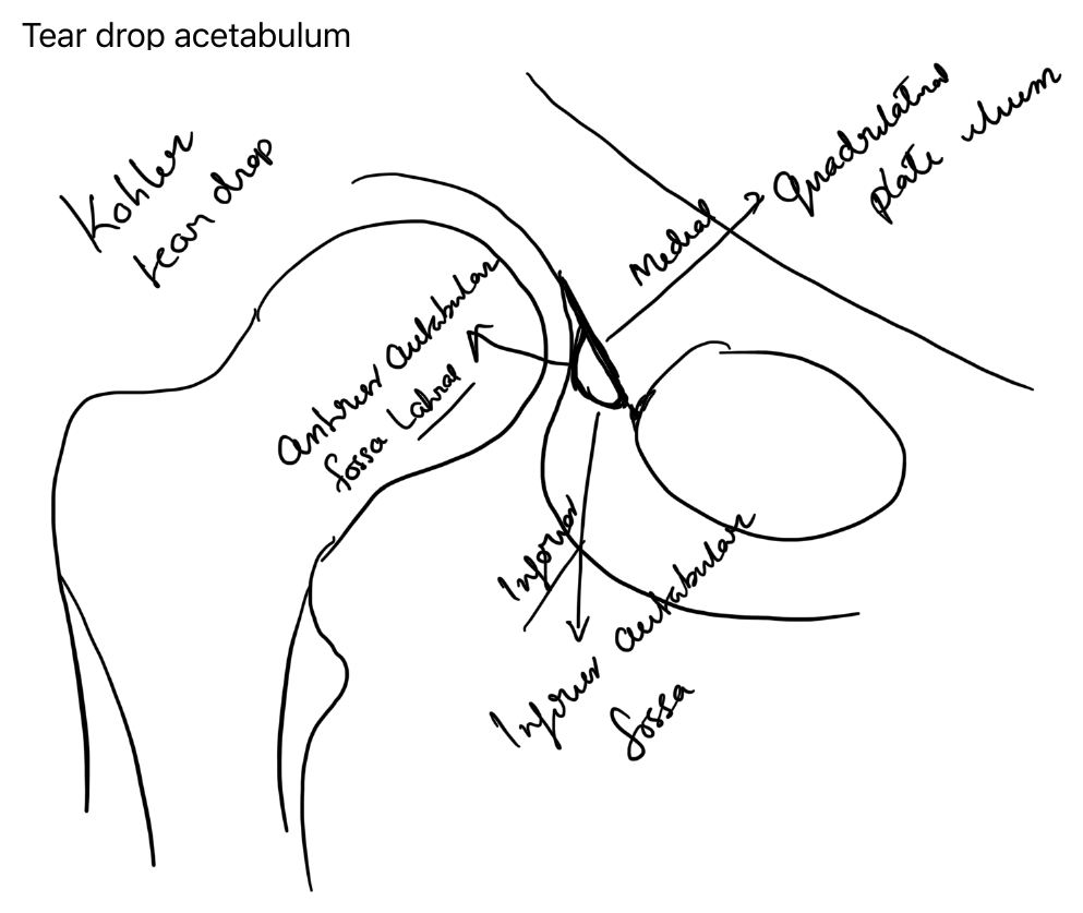 Acetabular teardrop