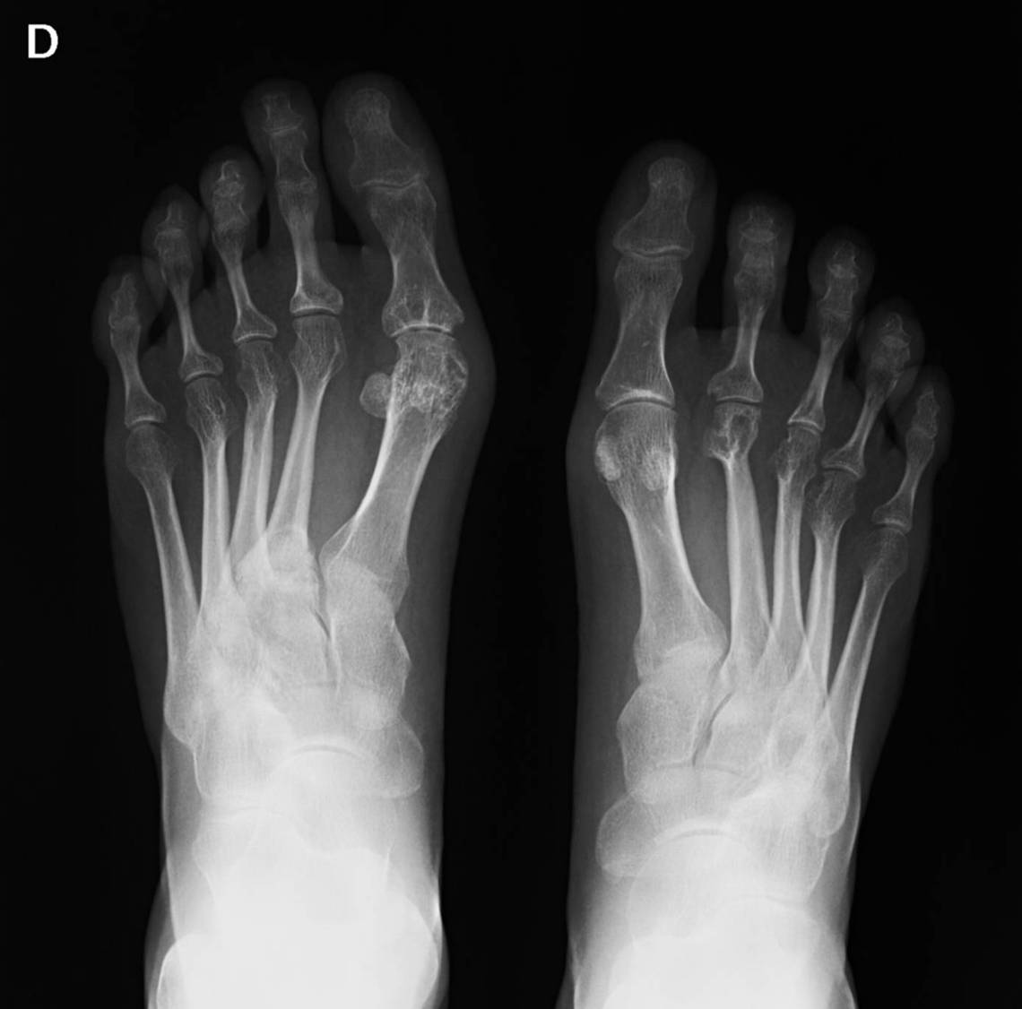 Radiograph of feet affected by rheumatoid arthritis