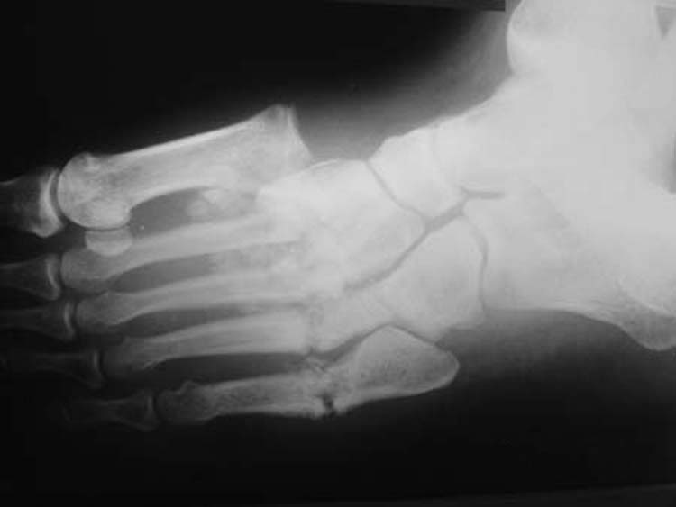 Charcot neuroarthropathy with Lisfranc disruption in a patient with diabetes