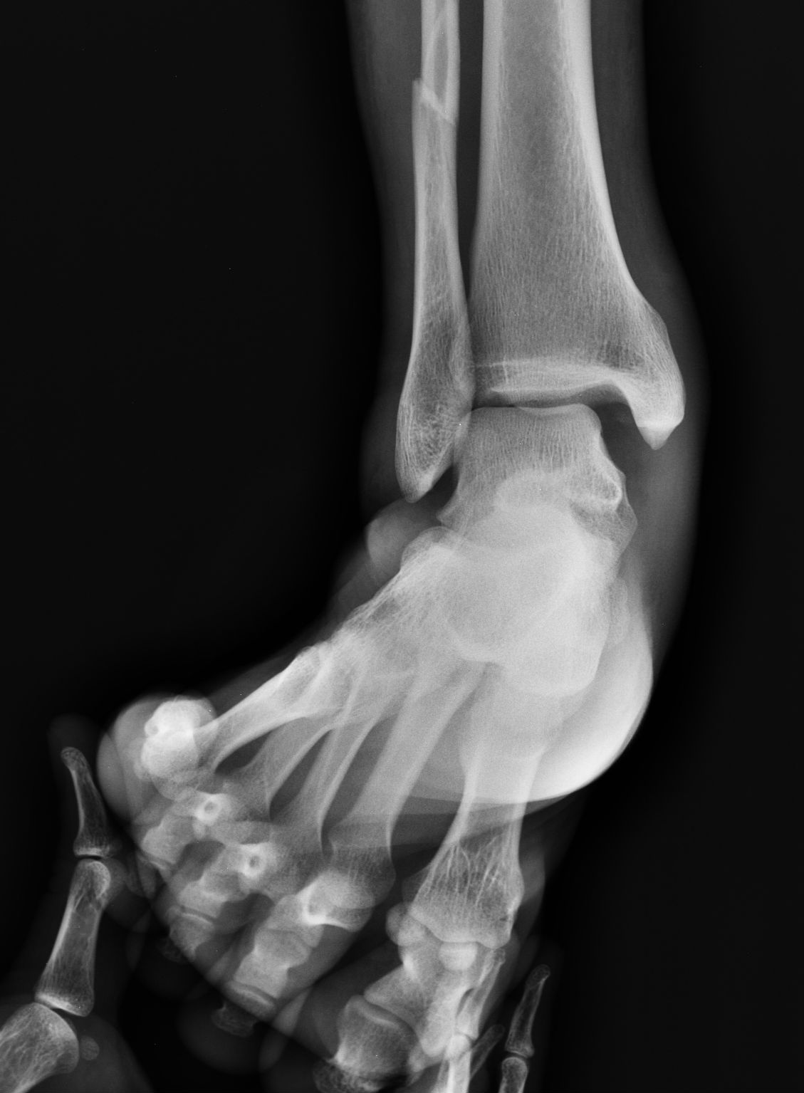 Ankle stress radiograph demonstrating instability