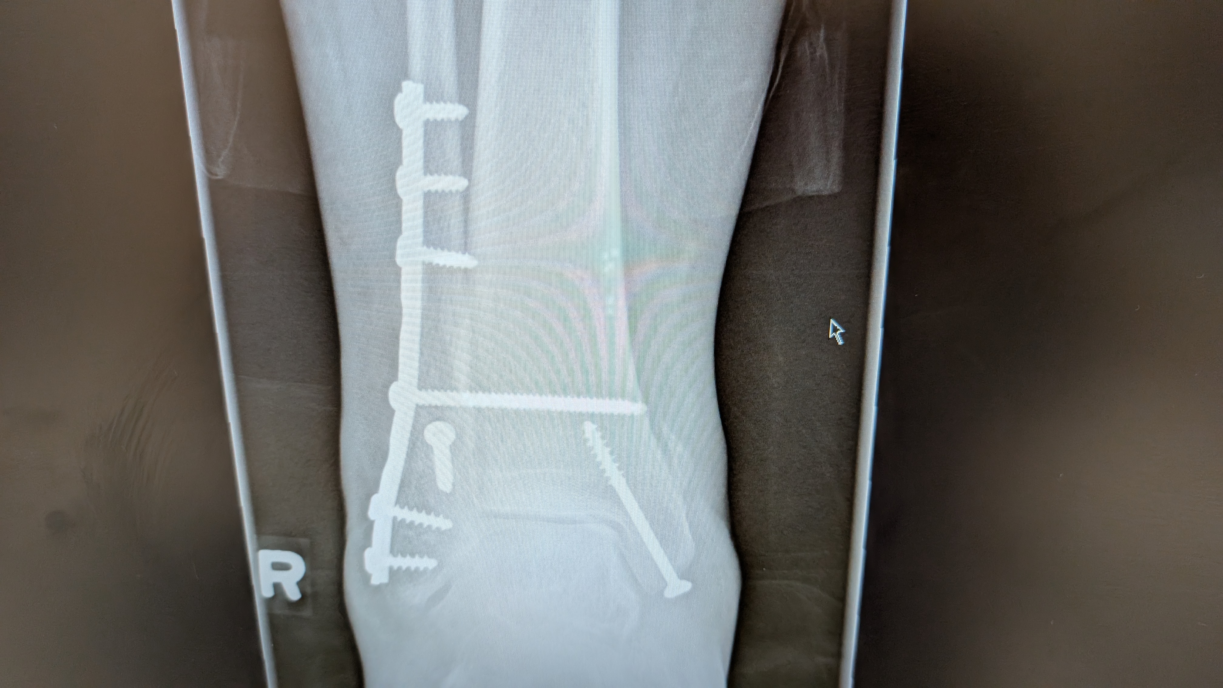 Plate fixation of an ankle fracture