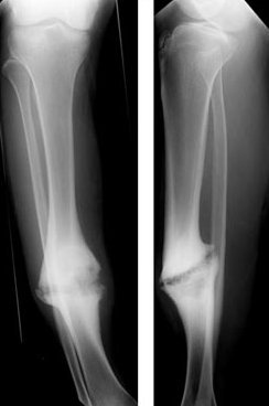 Hypertrophic tibial nonunion