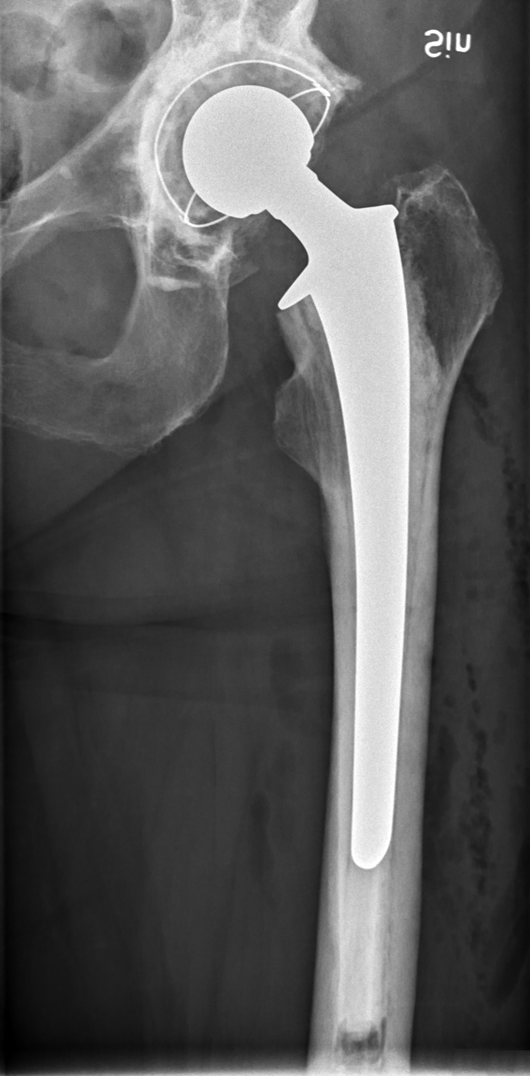 Cemented Lubinus total hip prosthesis on postoperative AP radiograph