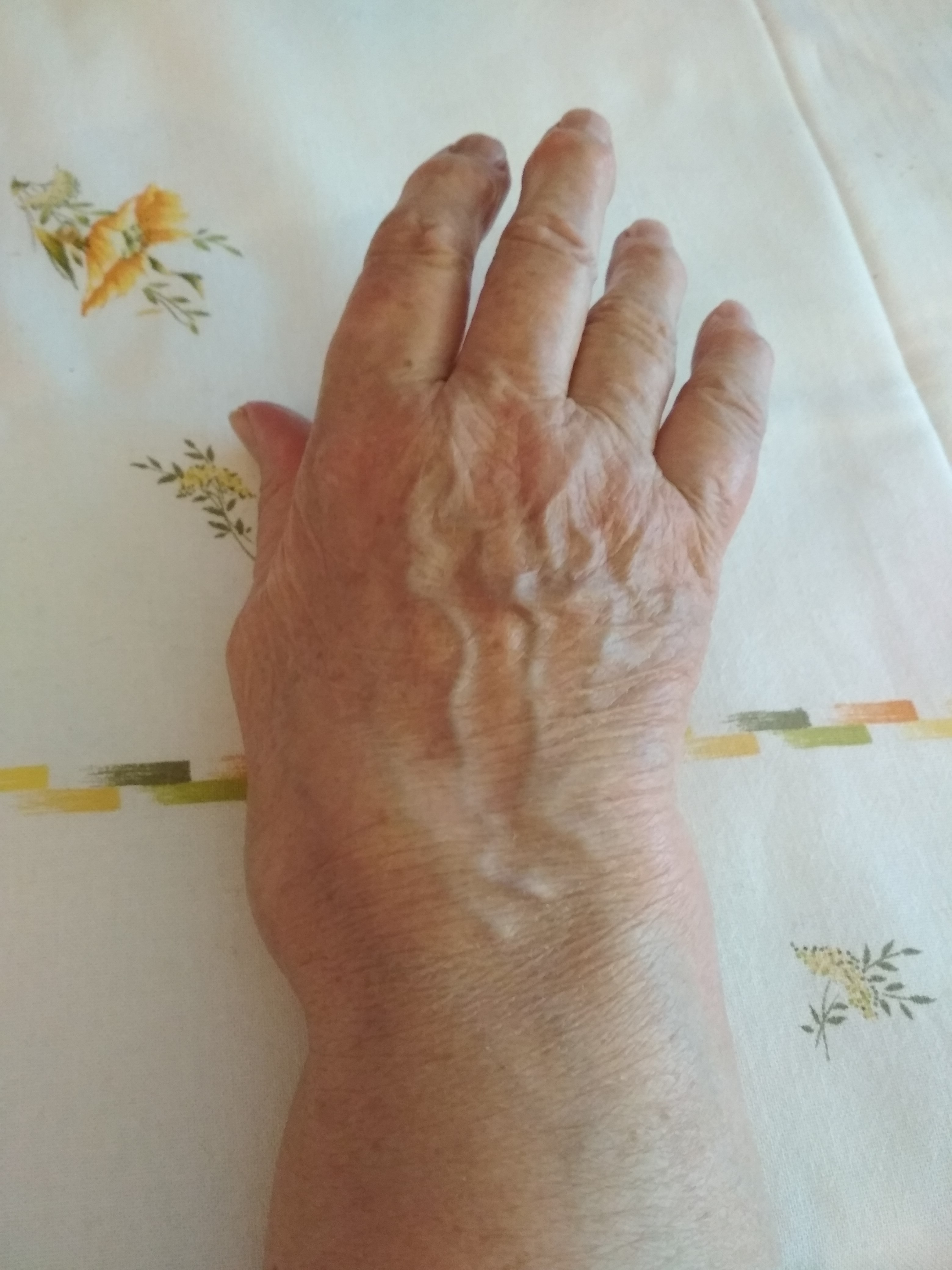 Clinical appearance of a hand affected by rheumatoid arthritis