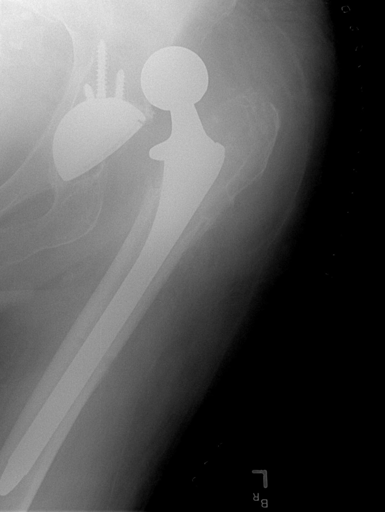 Dislocated total hip replacement