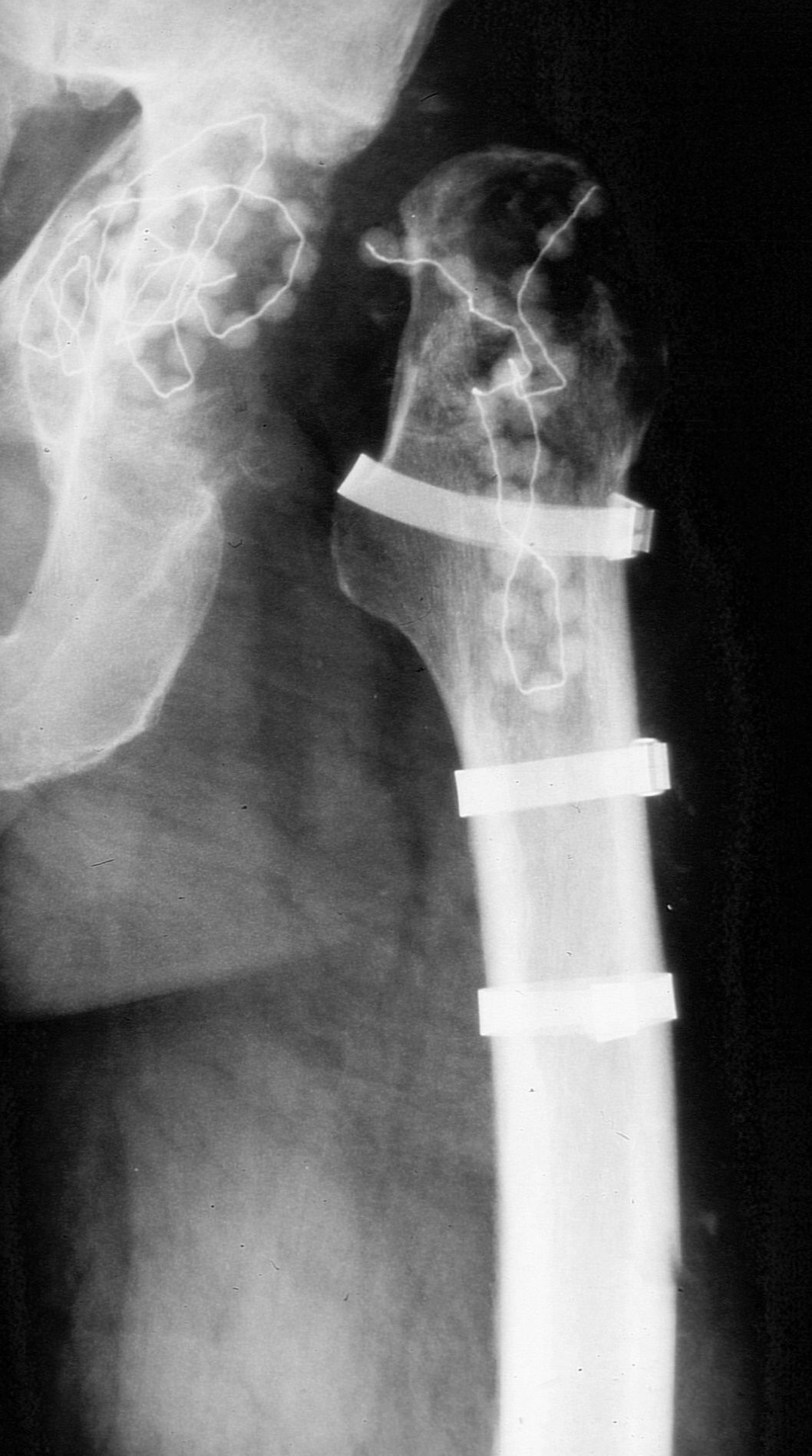 Girdlestone situation after removal of an infected hip prosthesis