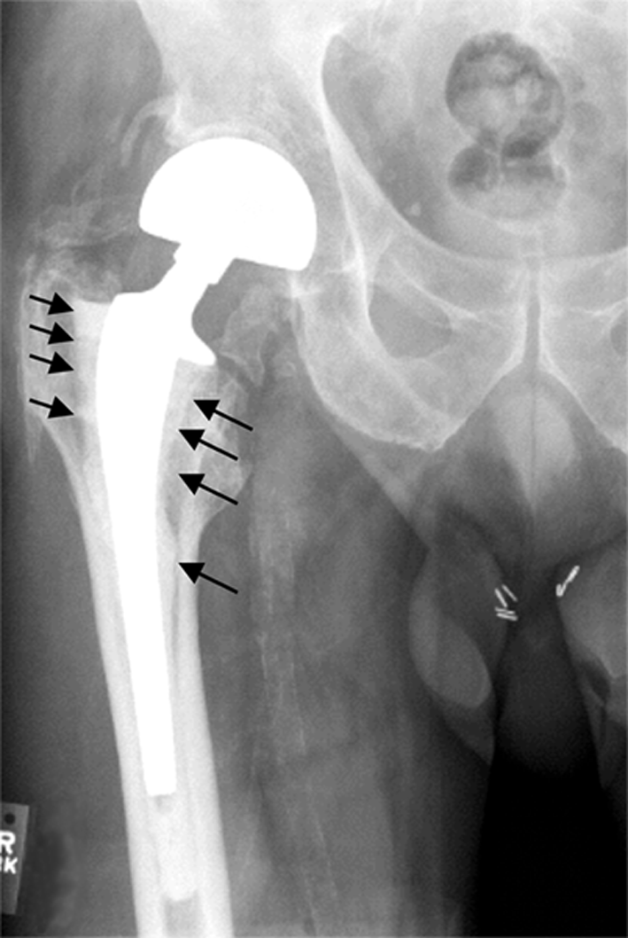 Peri-implant osteolysis in aseptic loosening before revision THA