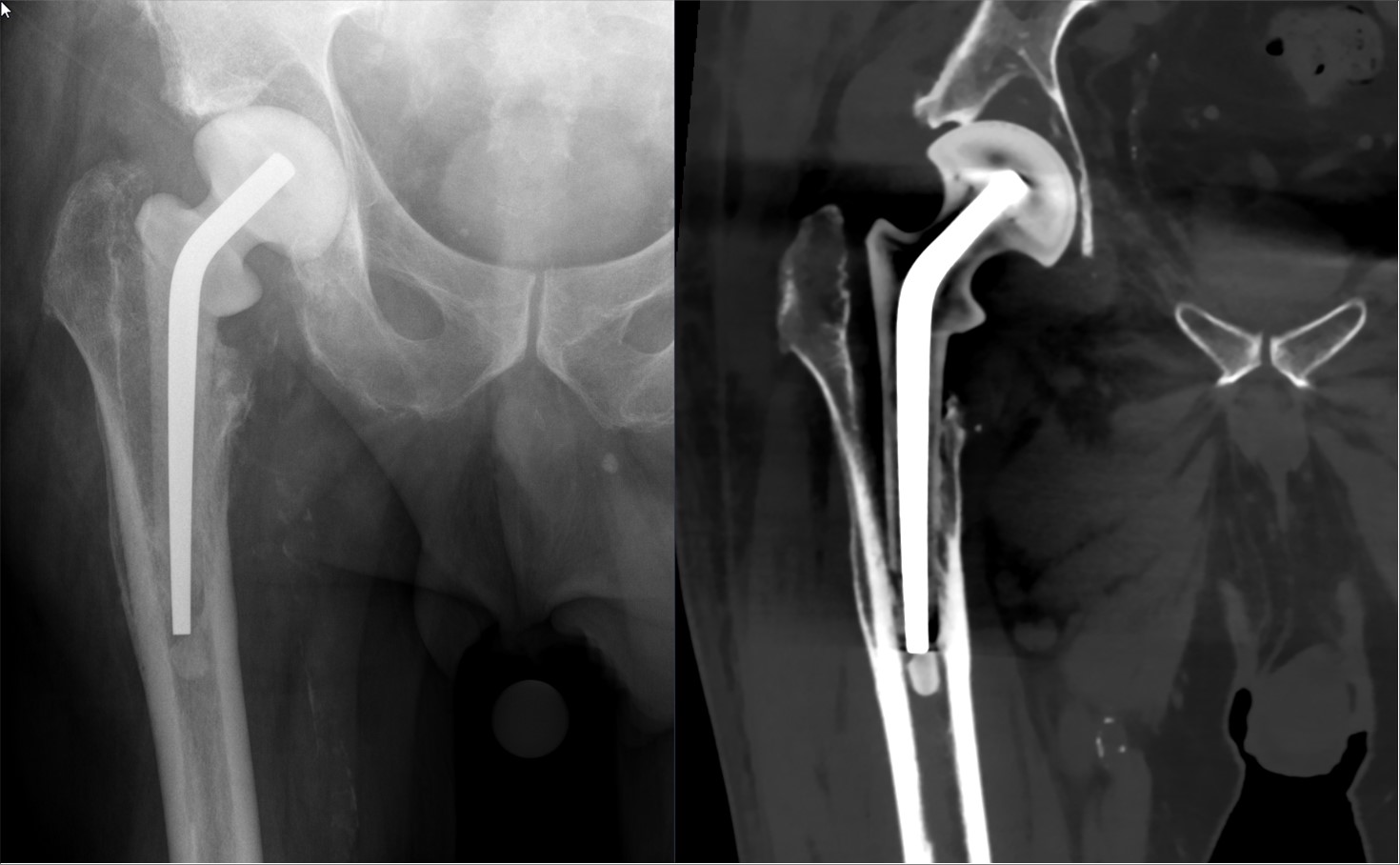 Temporary hip spacer used in treatment of an infected hip arthroplasty