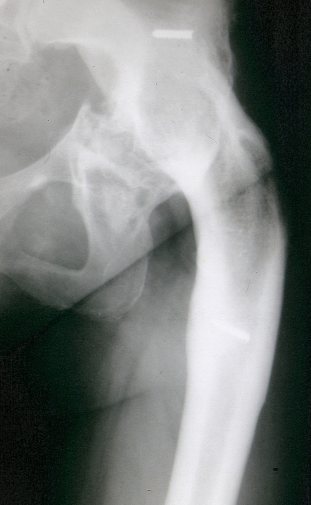 Radiograph of hip arthrodesis