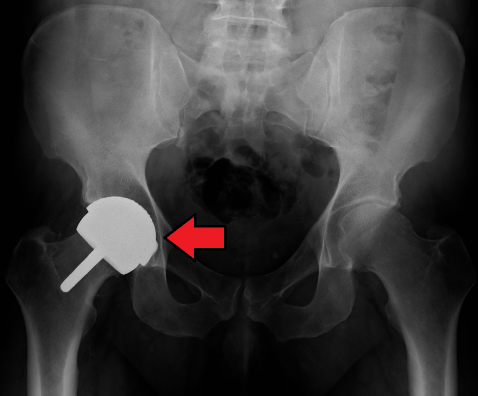 Metal-on-metal prosthetic hip