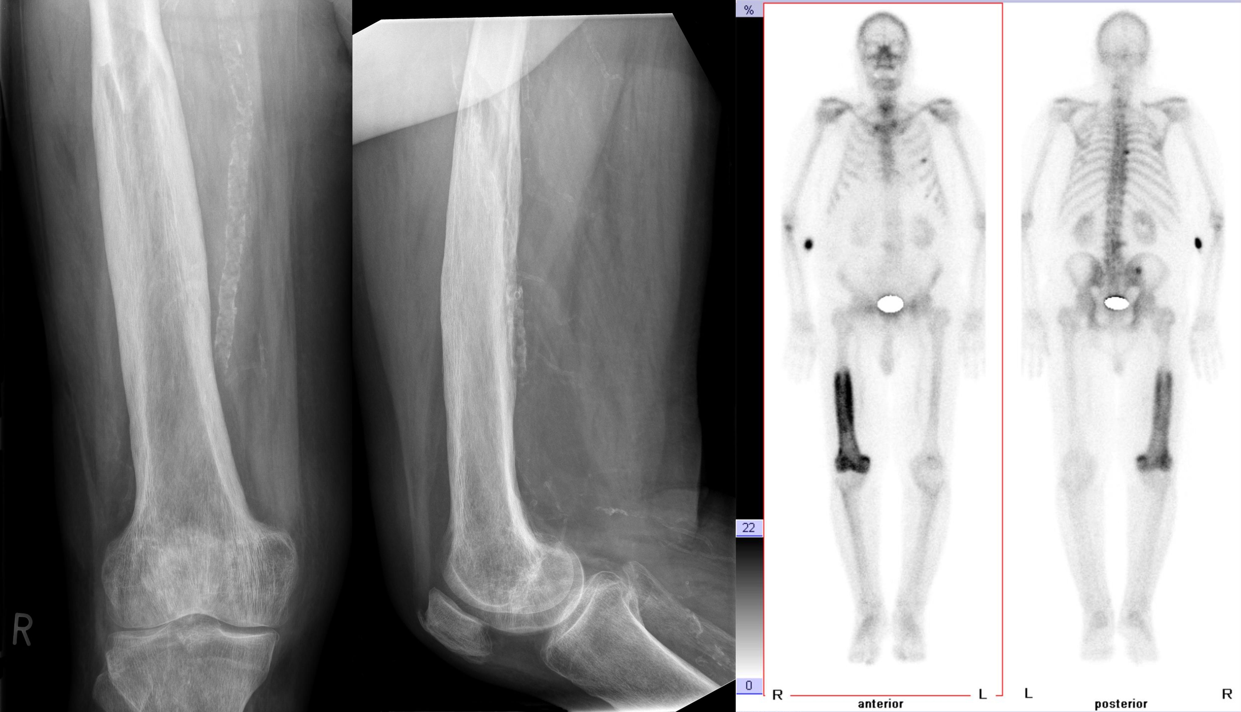 Radiographs and bone scan in femoral Paget disease