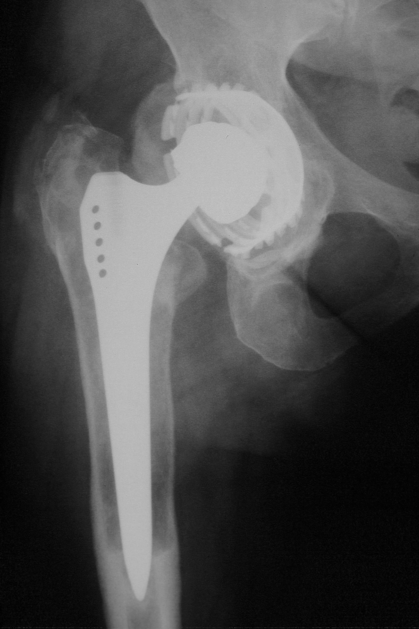 Massive osteolysis around a hip prosthesis; metallosis was found at revision