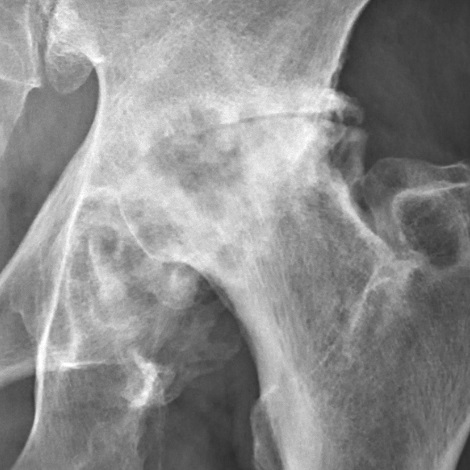 Severe hip osteoarthritis (Tönnis grade 3)