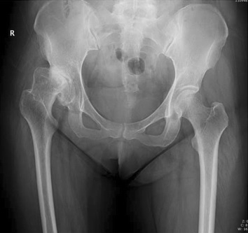 Adult developmental dysplasia of the hip