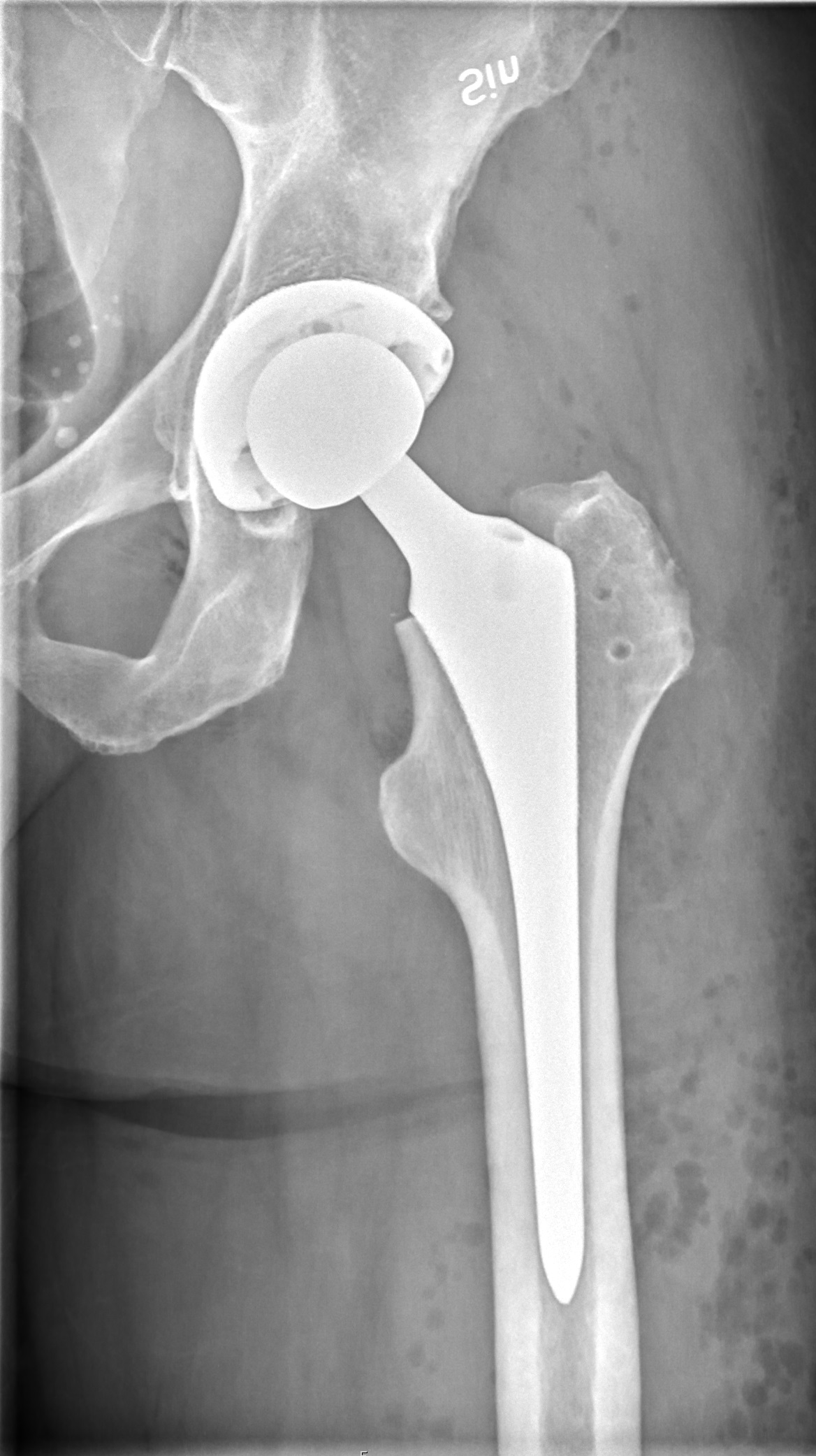 AP radiograph after total hip arthroplasty