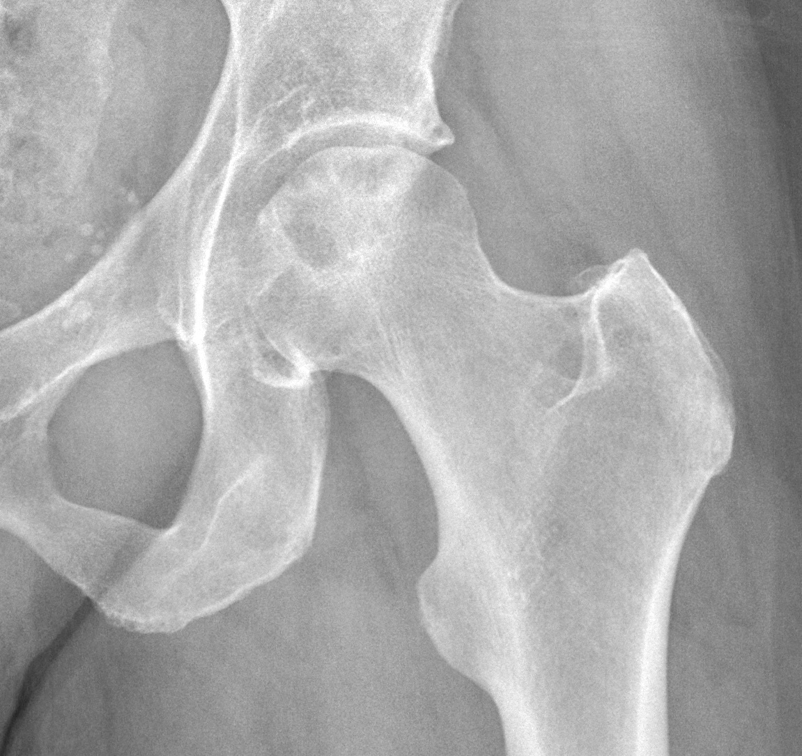 AP radiograph of avascular necrosis of the femoral head
