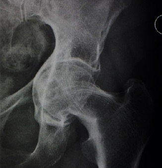 Radiographic appearance of protrusio acetabuli