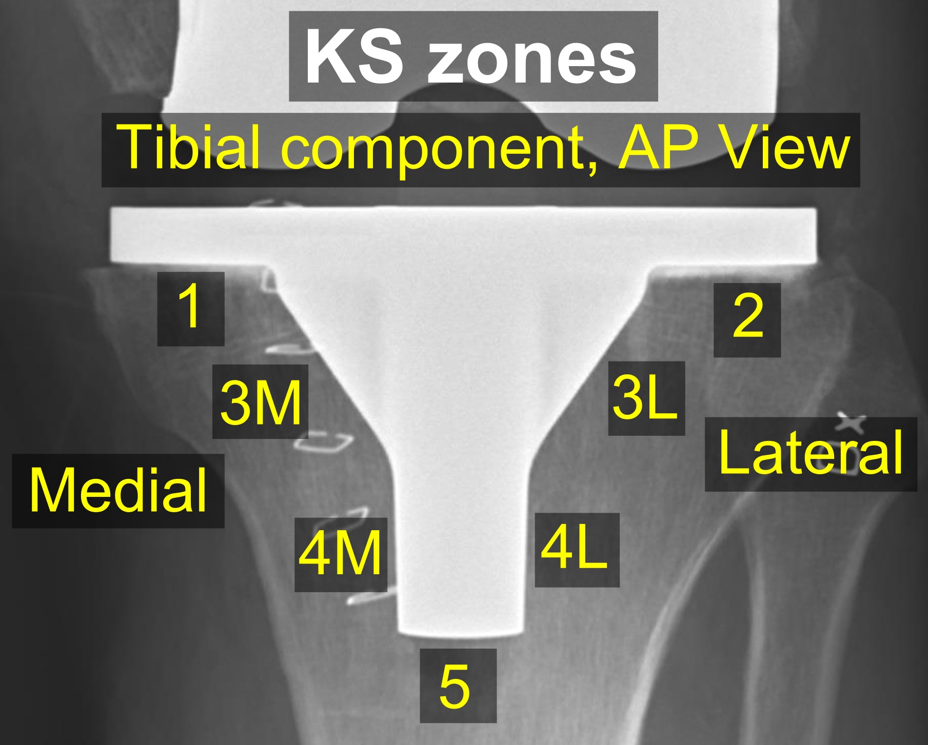 AP radiograph of a knee prosthesis showing Knee Society radiographic zones