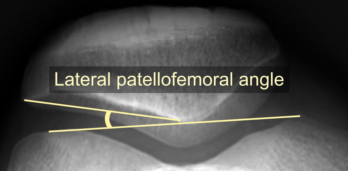 Axial patellofemoral radiograph demonstrating the lateral patellofemoral angle
