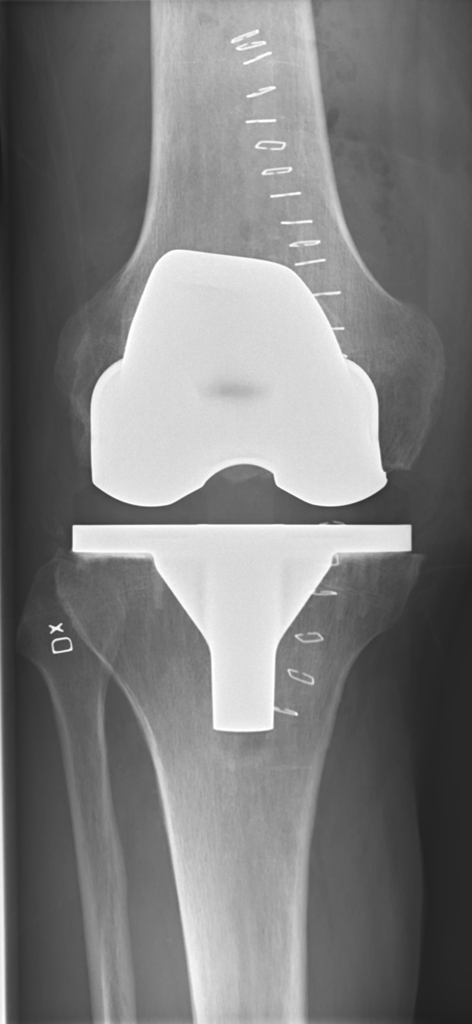 Postoperative AP radiograph of a total knee prosthesis