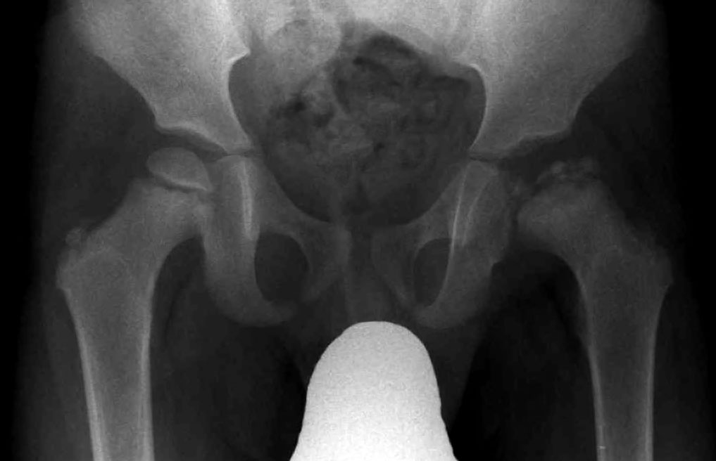Radiograph showing Legg–Calvé–Perthes disease