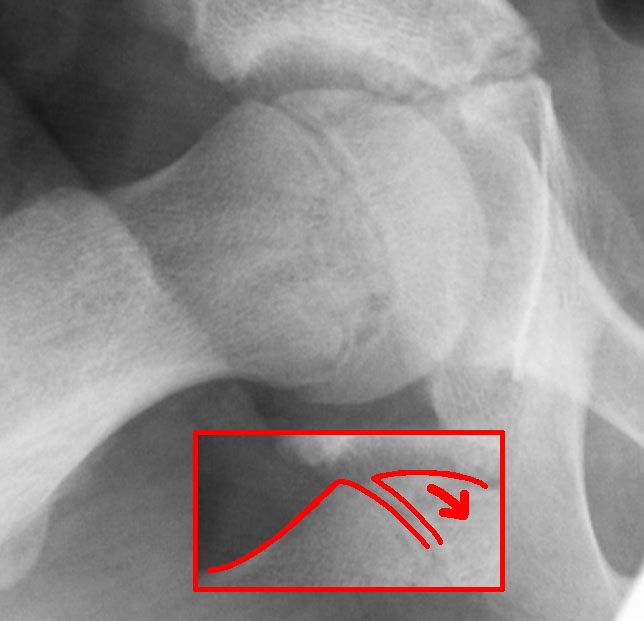 Radiograph showing slipped capital femoral epiphysis