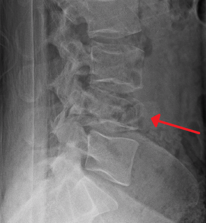 Lateral radiograph showing an L4 burst fracture