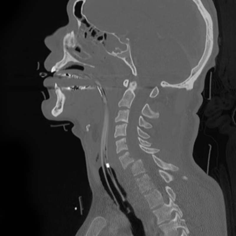 Sagittal CT reconstruction of a C6–C7 fracture-dislocation
