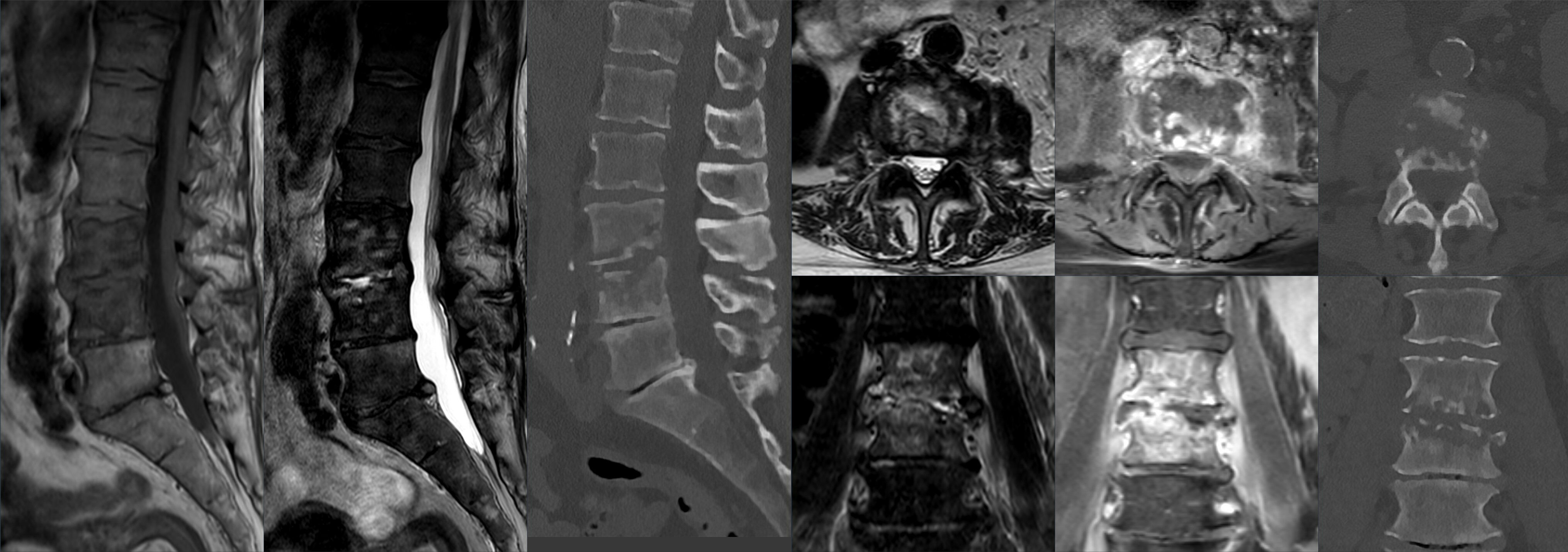 MRI and CT appearances of lumbar spondylodiscitis