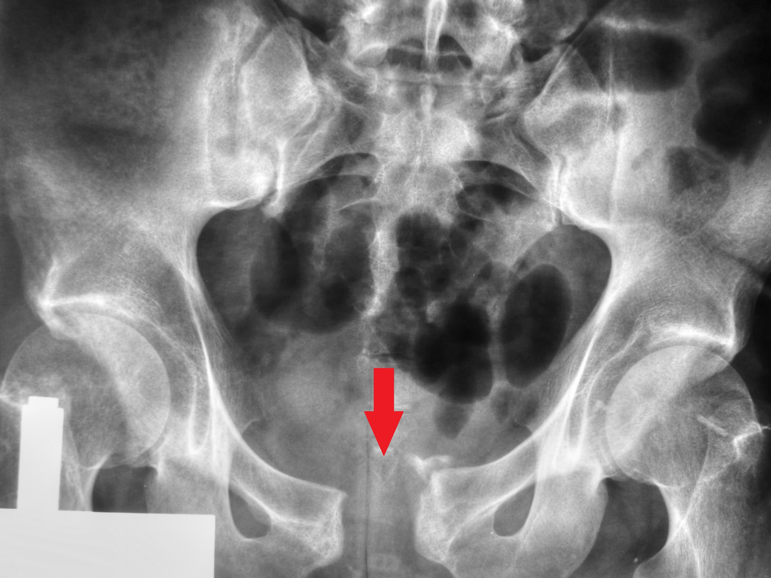 AP pelvic radiograph showing pubic symphysis diastasis
