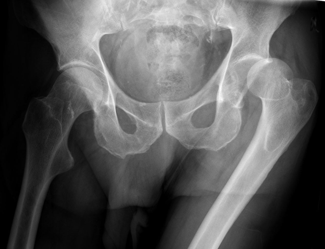 Radiograph of a left hip dislocation