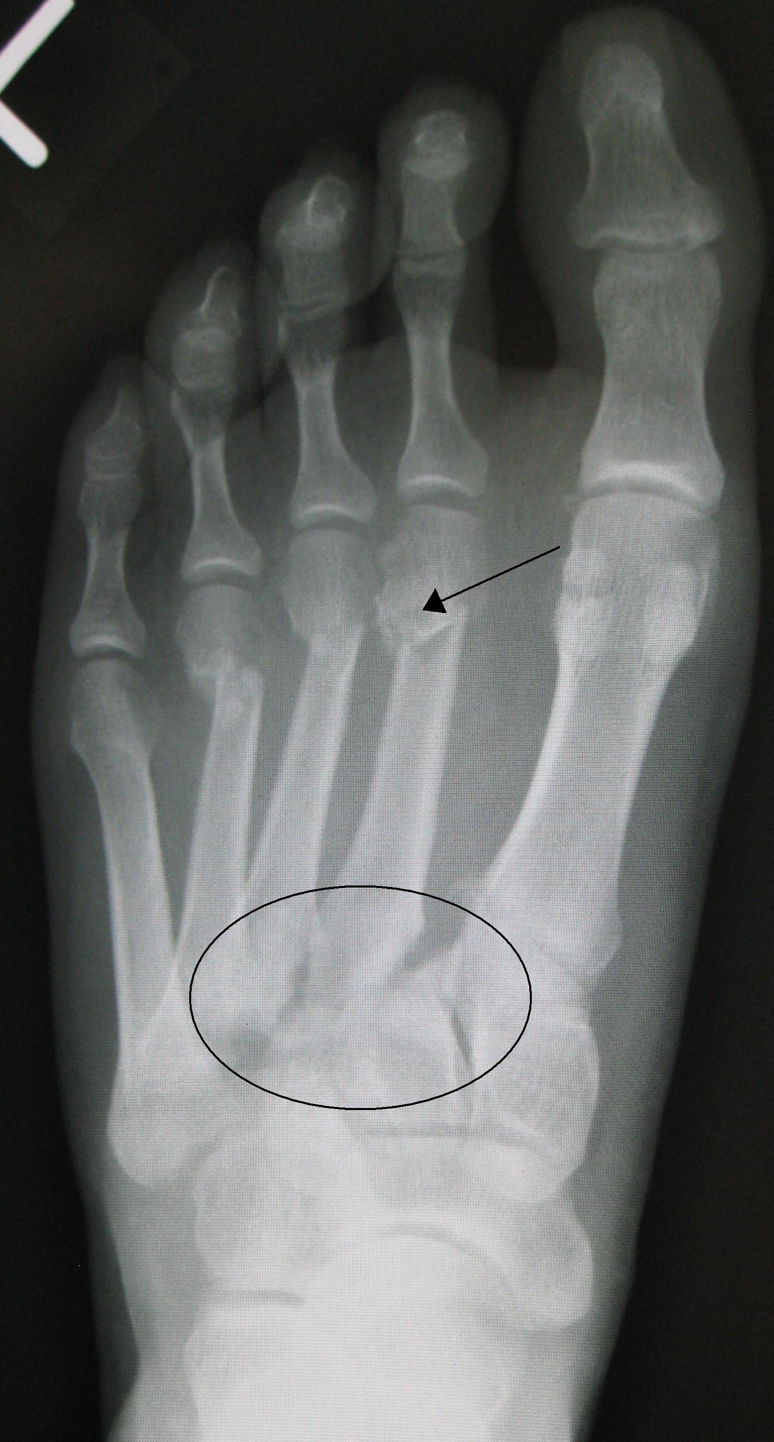 Radiograph of a Lisfranc fracture-dislocation