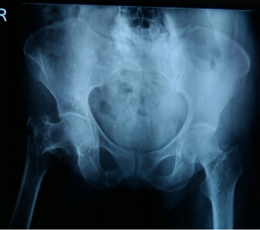 Radiograph of a right femoral neck fracture