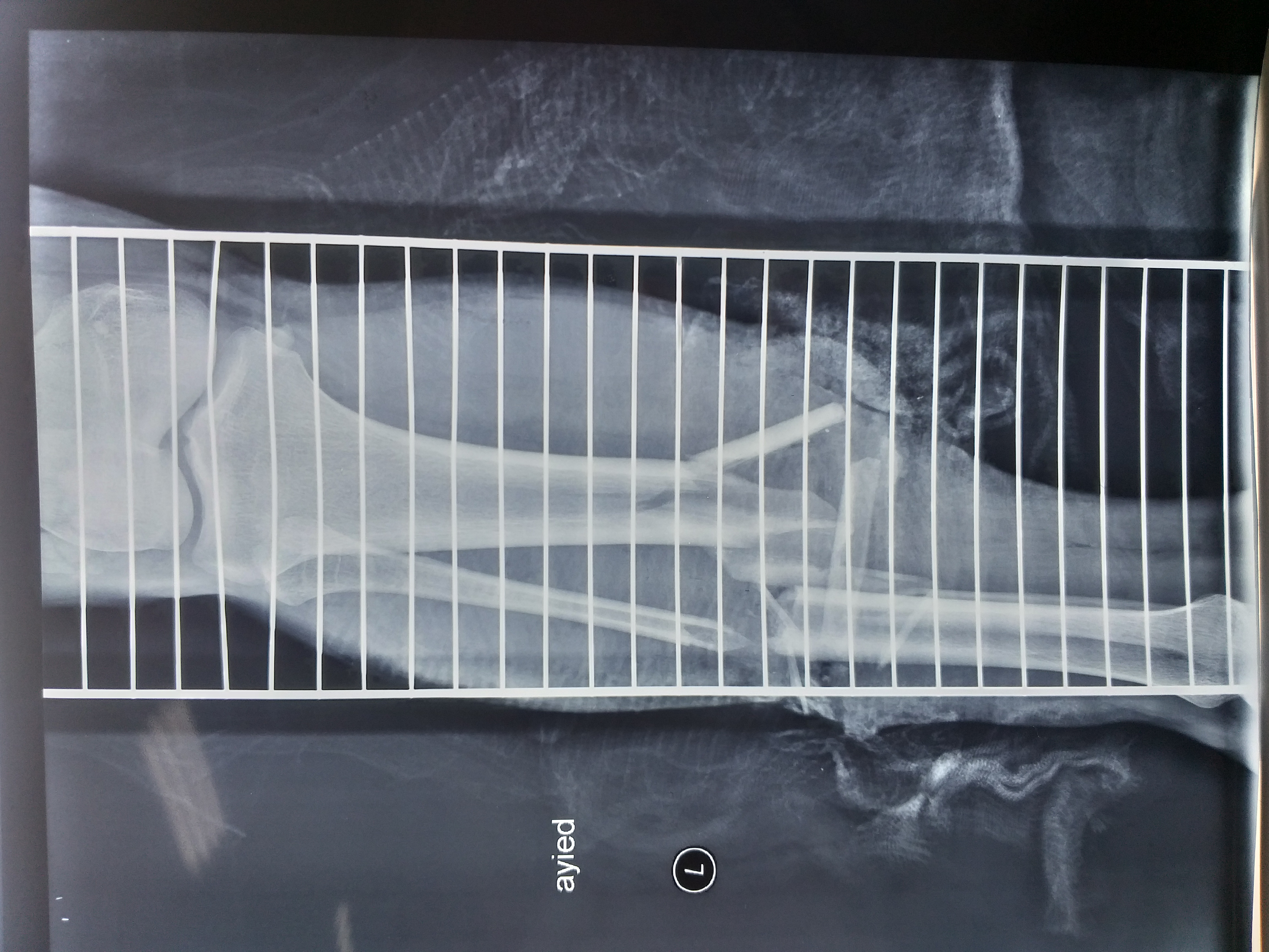 Clinical photograph of an open tibial and fibular shaft fracture