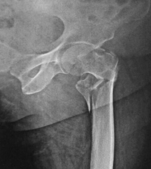Radiograph of a comminuted proximal femoral fracture